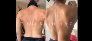 Before and After Back Acne images from TrueSkin Clinic in Calgary