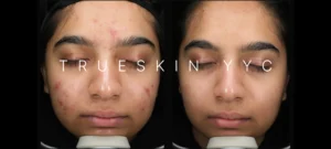 Face acne before and after results from TrueSkin Clinic in Calgary