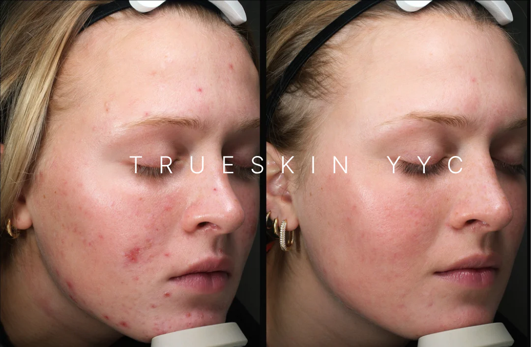 What causes acne?