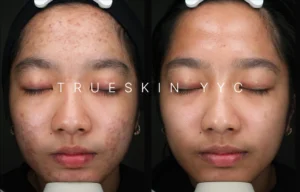 Why Do I Have Acne Before and After