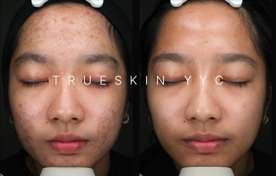 Why Do I Have Acne Before and After